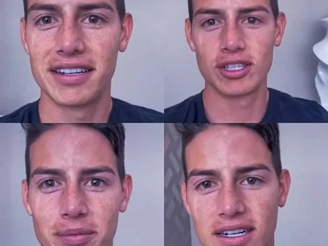 El verano hizo dolorosos estragos en el rostro de James Rodríguez