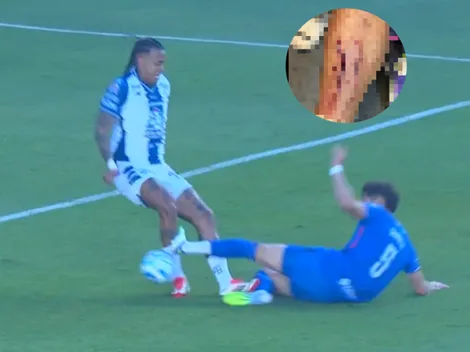 Así le quedó la pierna al Chiquete Orozco tras su expulsión