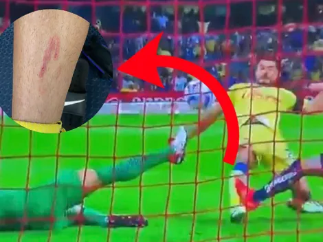 La marca que le dejaron a Henry Martín tras el planchazo en el Clásico Capitalino