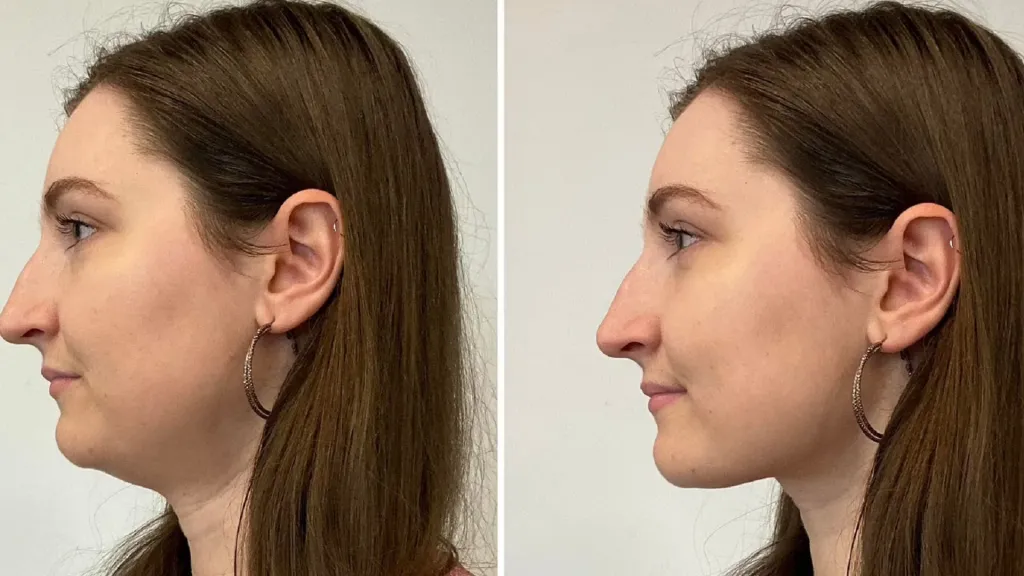 El reto del Mewing es furor en Tiktok.