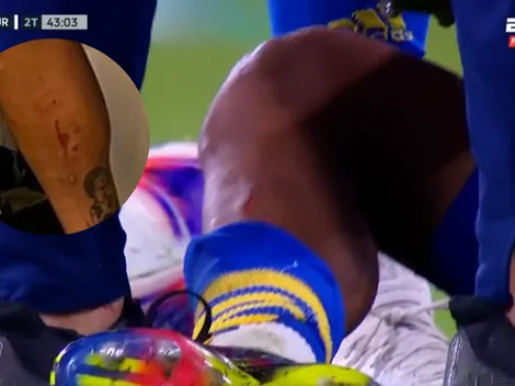 ESCALOFRIANTE: así le quedó la pierna a Medina tras la patada que sufrió en Boca-Huracán