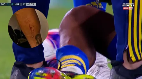 ESCALOFRIANTE: así le quedó la pierna a Medina tras la patada que sufrió en Boca-Huracán