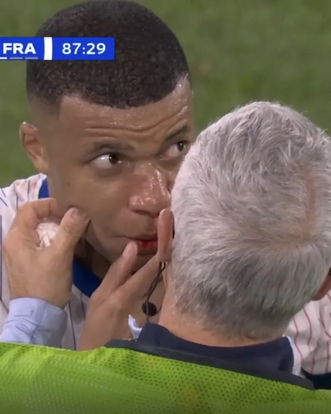 Así quedó el rostro de Mbappé. (Foto: ESPN)