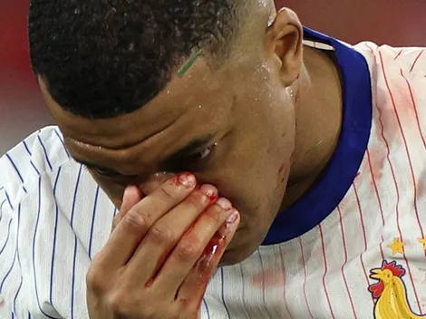 Así quedó la nariz de Mbappé tras el golpe en la cara que sufrió ante Austria