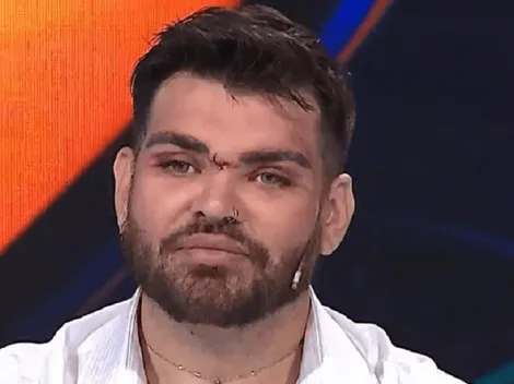 FOTOS: El antes y después de Fran Mariano, quien sufrió mala praxis por parte de Aníbal Lotocki