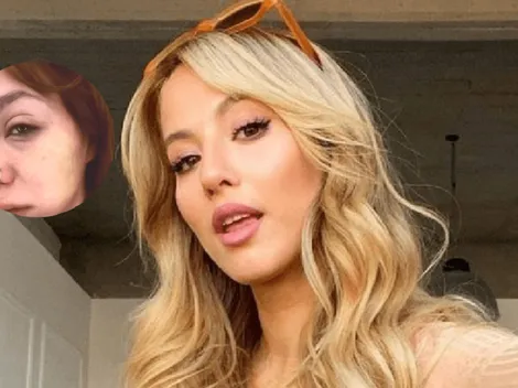 Qué le pasó a Flor Vigna en su rostro y cuánto tiempo de recuperación tiene