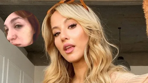 Se le hinchó el rostro a Flor Vigna.