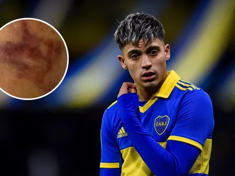 Impactante: así quedó el tobillo de Zeballos tras la patada y la operación