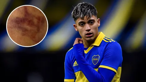 Impactante: así quedó el tobillo de Zeballos tras la patada y la operación