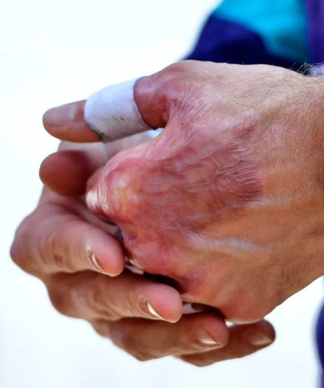 La quemadura en la mano de Grosjean es el recuerdo viviente de lo que atravesó.