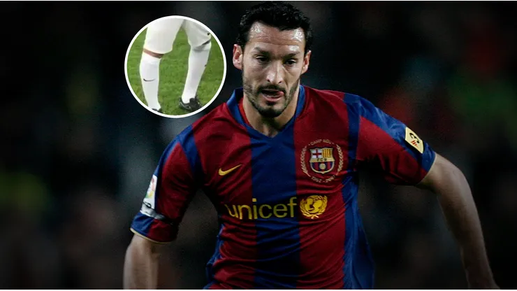 Gianluca Zambrotta sufre una extraña deformidad.