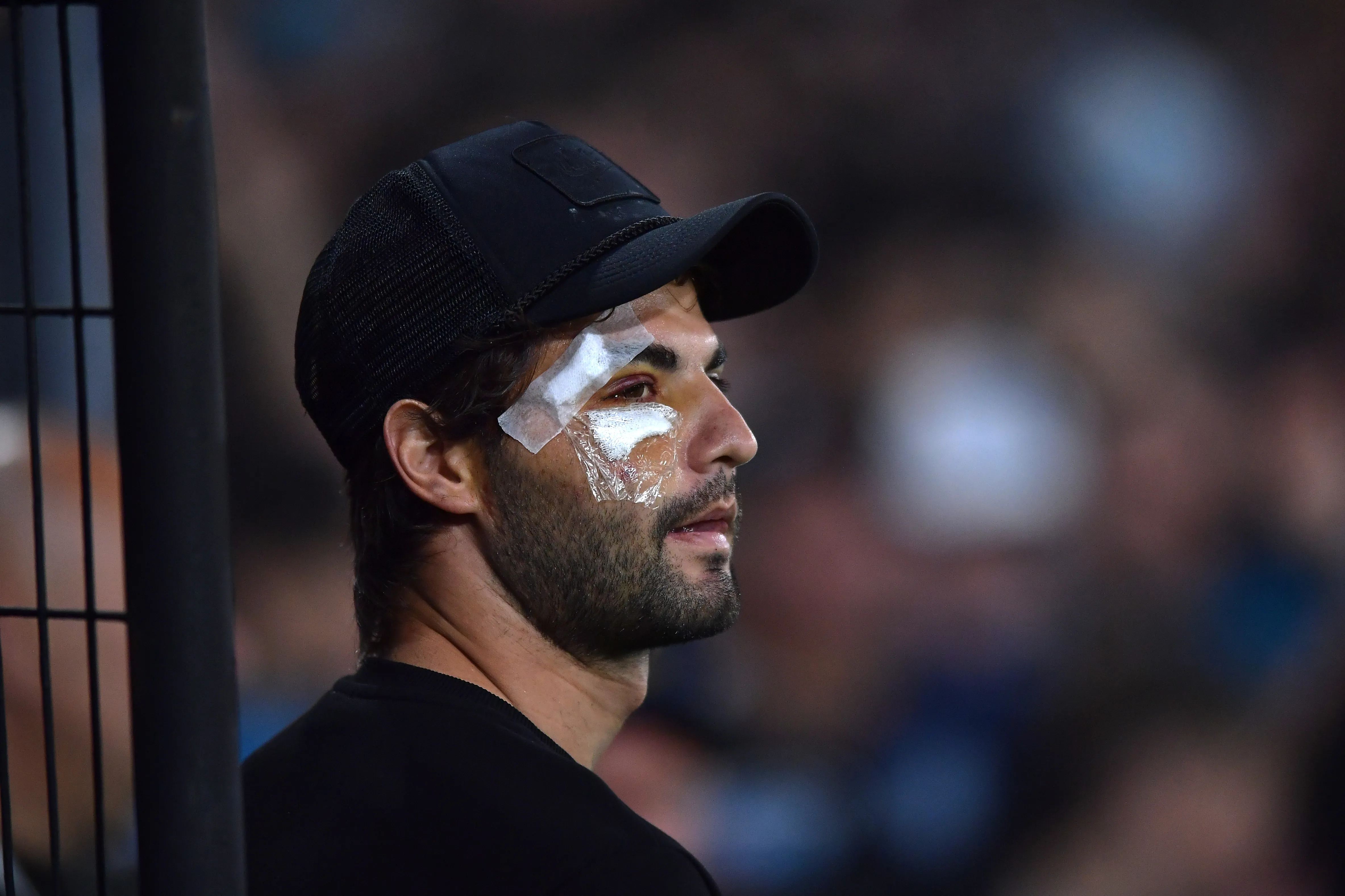 Así lucía el rostro de Santiago Sosa días después de la cirugía en el seno maxilar superior derecho (Getty Images).
