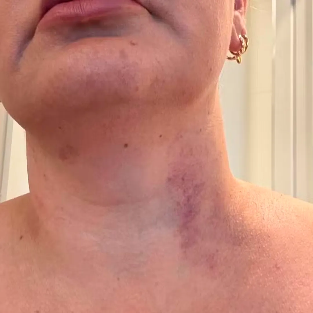 El cuello de la mujer que denuncia a Ryan Mendes. (Foto: GeGlobo)