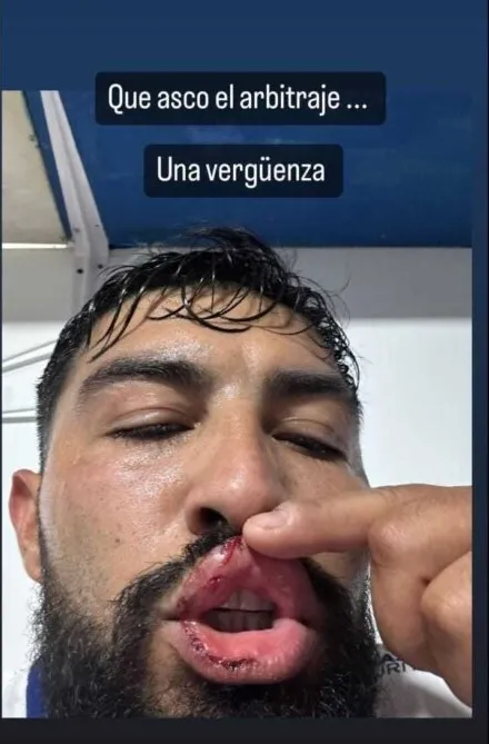 Así quedó Nicolás Maturana. | Foto: Instagram