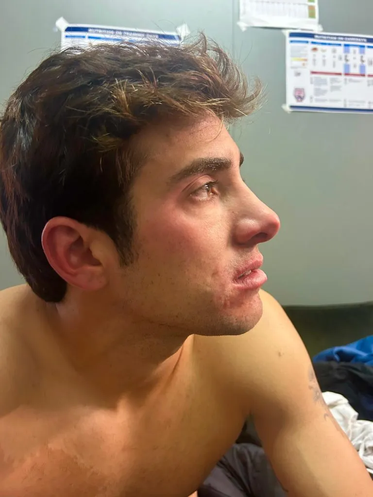 Así quedó Garin tras el golpe de Bergs | Foto: Tenis Chile