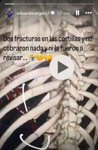 La fractura de Eduardo Vargas. (Foto: Instagram)