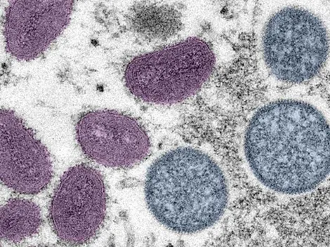 Viruela del Mono en México: cuántos casos confirmados hay en tu Estado