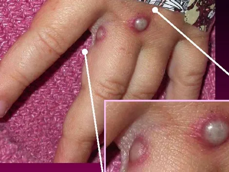 ¿Cuántos casos de viruela del mono hay en México hasta el 23 de julio?