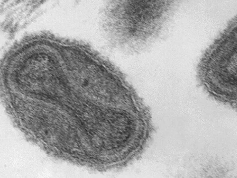 Viruela de Mono: detectan el segundo caso en la Ciudad de México