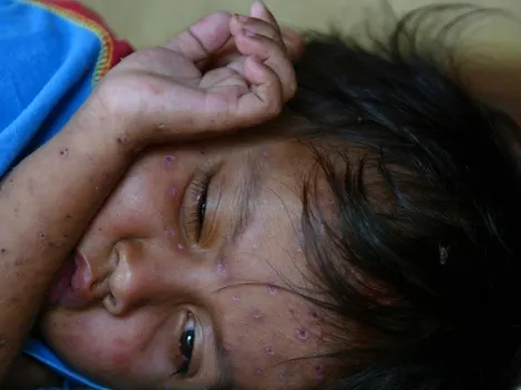 Viruela del mono: Recomendaciones de la UNAM para protegerse de la viruela símica