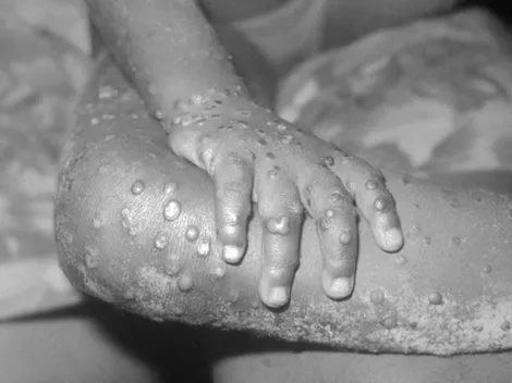 Viruela del mono: México activa alerta epidemiológica por la viruela símica
