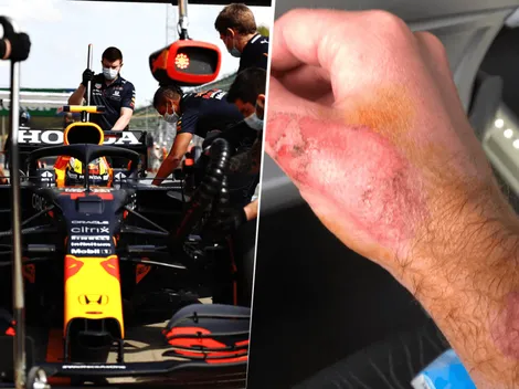 FOTO: La herida que le dejó Checo Pérez al mecánico de Red Bull