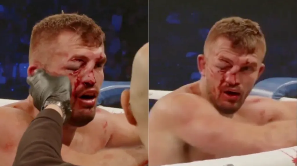 Así lucía el rostro de Kyle Redfearn instantes antes de que le detengan la pelea de boxeo sin guantes. (MMAJunkie)