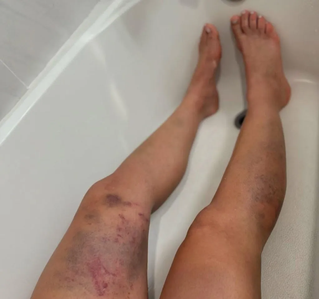 Así quedaron las piernas de Ailín Pérez luego de su pelea vs. Karol Rosa en UFC 311.