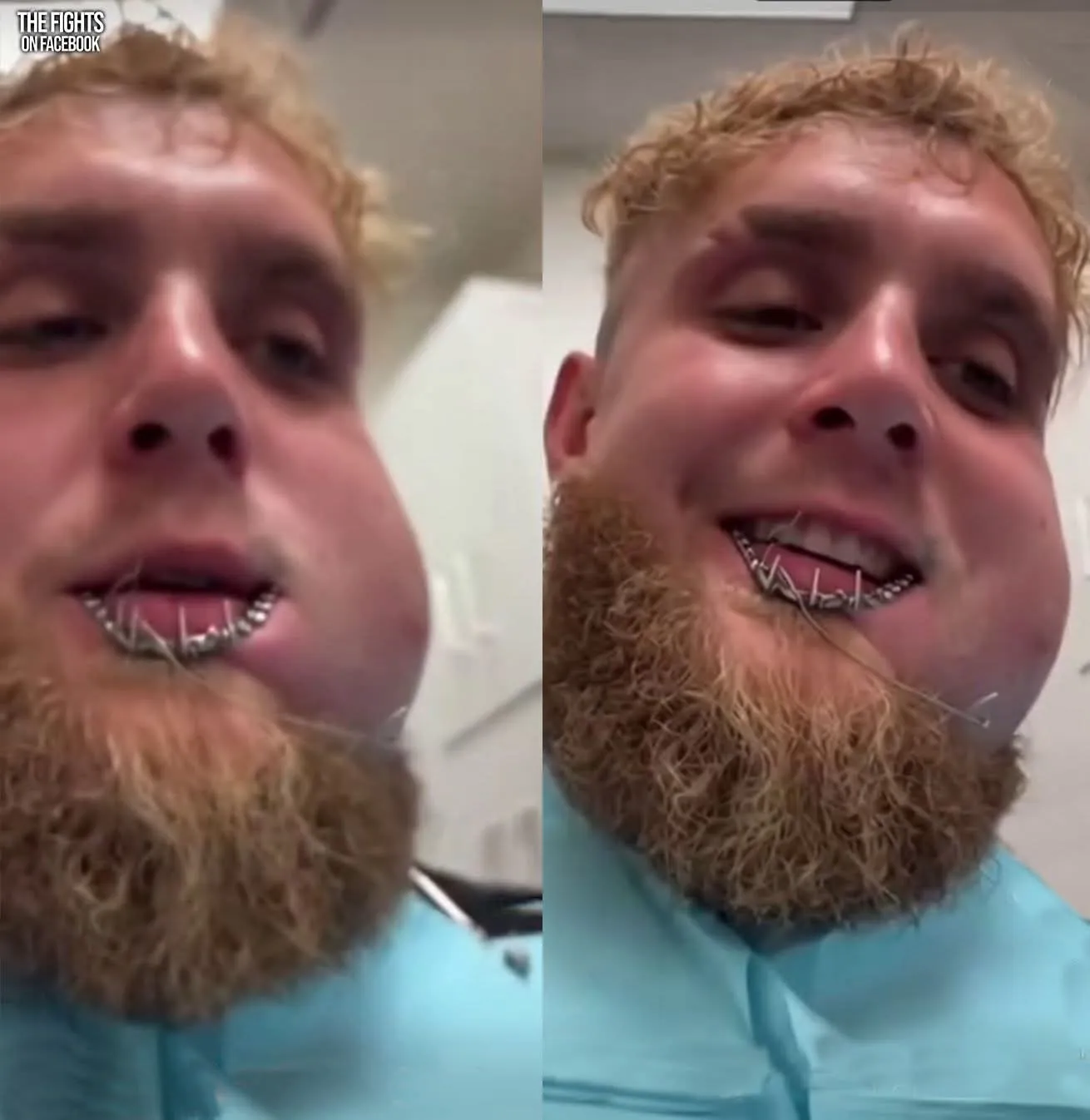 Jake Paul sufrió los daños de su pelea con Anthony Joshua. (X)