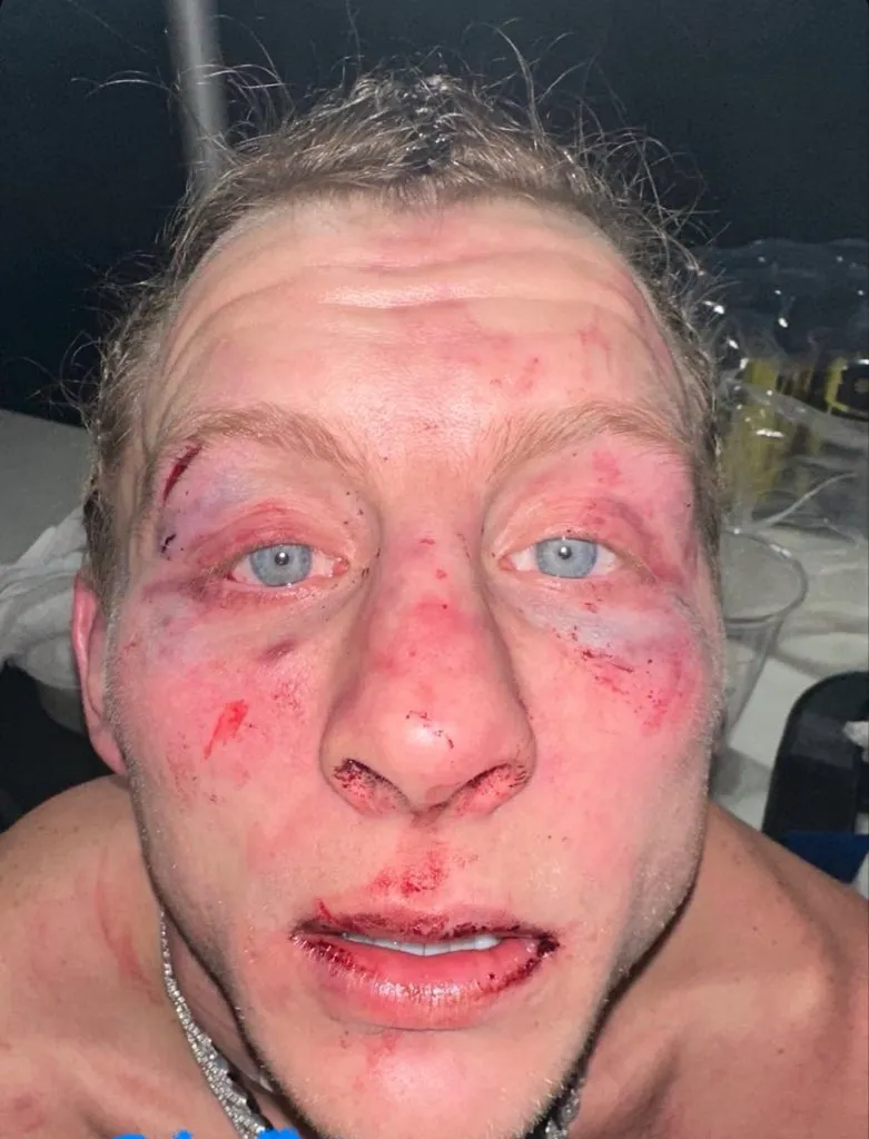 Paddy Pimblett terminó muy herido su pelea ante Justin Gaethje en UFC 324. (X)