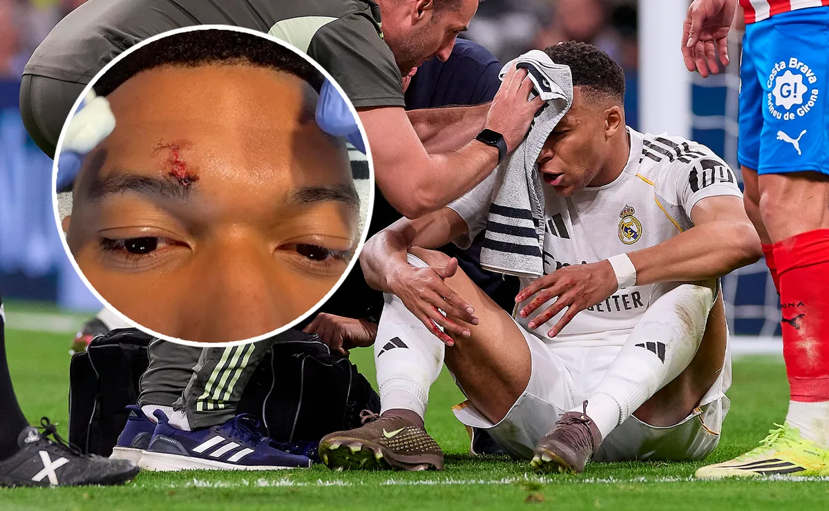 Así quedó el rostro de Mbappé tras el codazo ante Girona - Bolavip Mexico