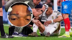 Kylian Mbappé recibió puntos de sutura por el codazo en Real Madrid vs. Girona