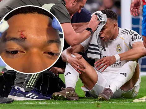 Así quedó el rostro de Mbappé tras el codazo ante Girona