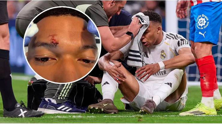 Kylian Mbappé recibió puntos de sutura por el codazo en Real Madrid vs. Girona