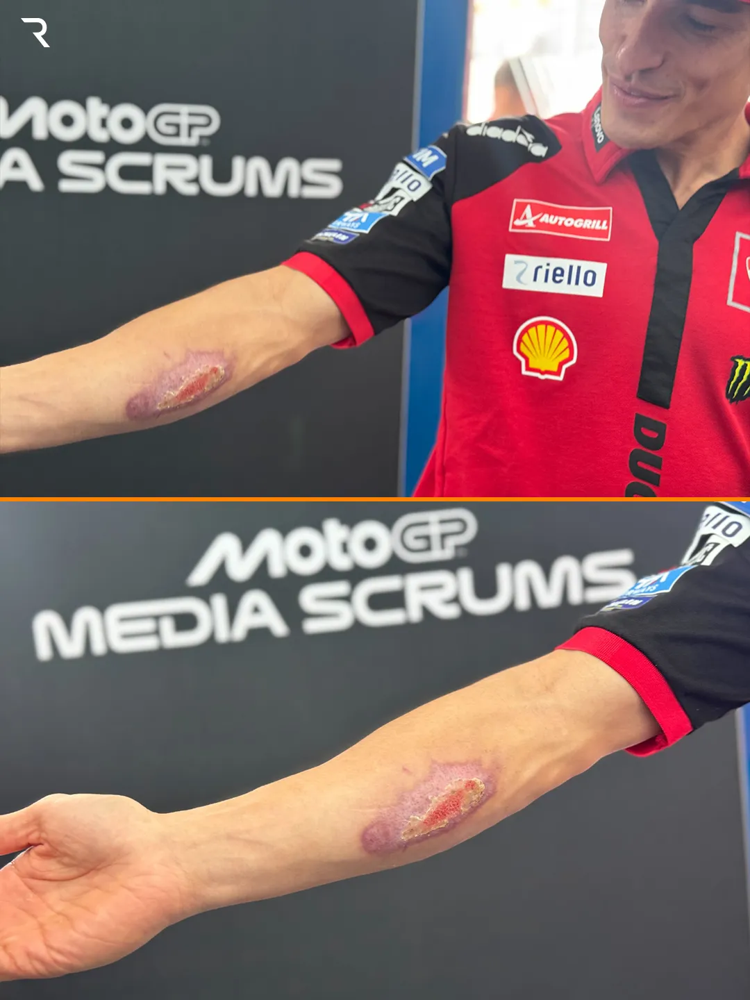 Marc Márquez mostró su herida (Foto: @TheRaceMoto)