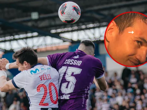 Así quedó el rostro de Jairo Vélez luego del penal no cobrado a Alianza Lima