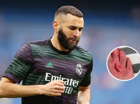 Cinco puntos de sutura: Benzema jugó con un corte en el pie