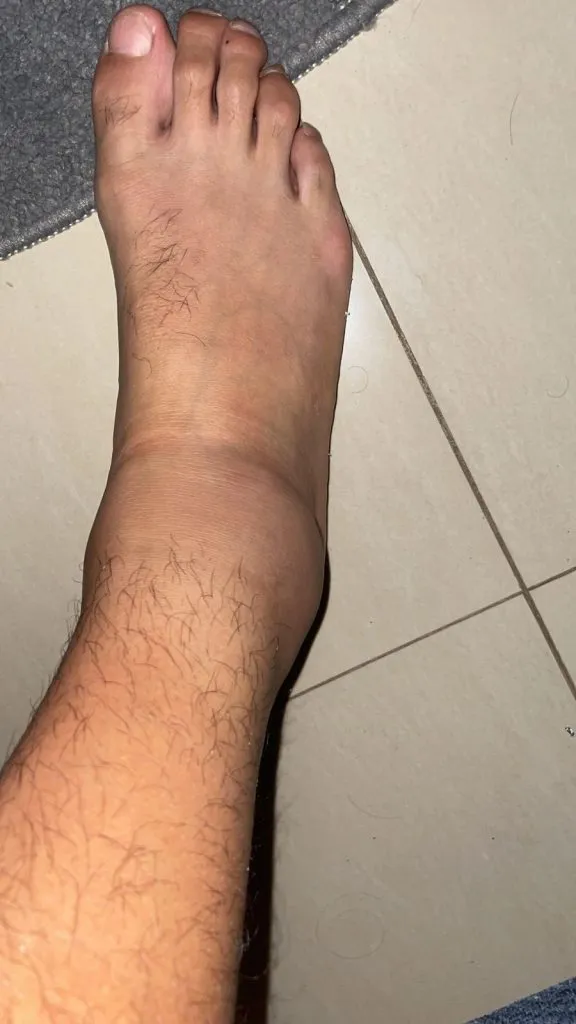 Así quedó el tobillo de Tommy Chamba tras el partido ante Deportivo Cuenca. (Foto: @sportcapitalec)