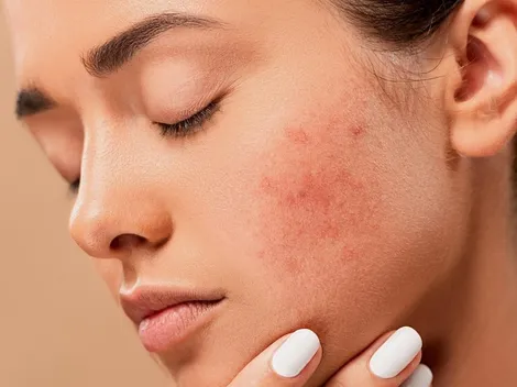 Aprende a reconocer los tipos de acné para tratarlos adecuadamente