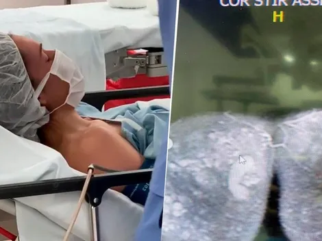 Lina Tejeiro publicó toda la cirugía de cómo le sacaron unos biopolímeros