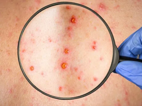 Hay 67 casos de sarampión en CDMX en medio de la pandemia por Coronavirus