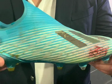 Jugador peruano se lesionó y tildó de desleal a Yerry Mina por fuerte pisotón