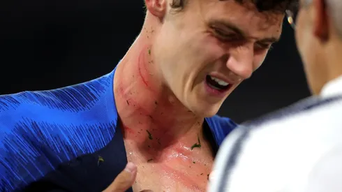 Foto de Pavard y las marcas en su cuello.