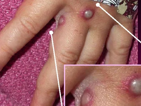 Cuáles son las similitudes y diferencias entre la viruela del mono y la viruela humana