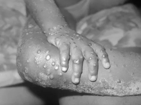 Viruela del Mono: cuáles son los países más afectados hasta el momento