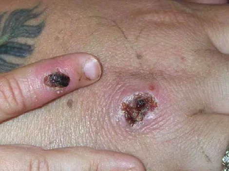 Viruela del mono: qué es, cómo se transmite y cuáles son sus síntomas