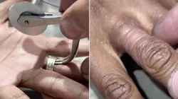 Mulher tira anéis que ficaram presos em seu dedo por mais de 15 anos
