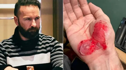 Daniel Negreanu machucou a mão durante a WSOP (Foto: Reprodução PokerGo e Reprodução twitter oficial Daniel Negreanu @realkidpoker)