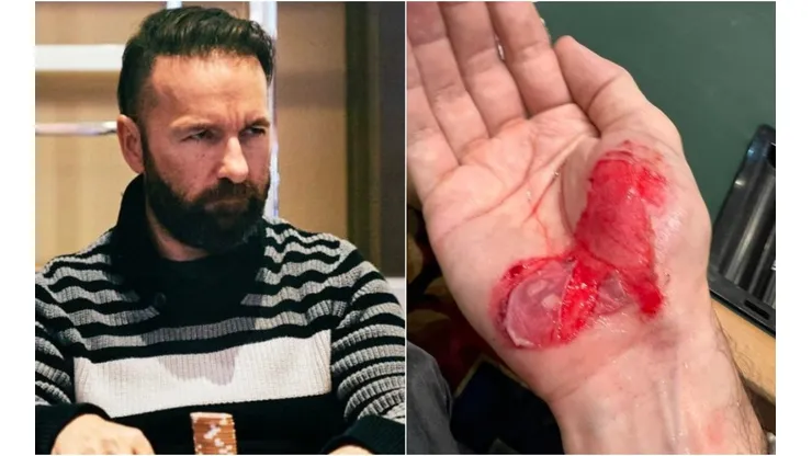 Daniel Negreanu machucou a mão durante a WSOP (Foto: Reprodução PokerGo e Reprodução twitter oficial Daniel Negreanu @realkidpoker)