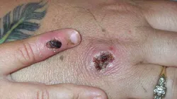 O caso é considerado importado, porque o homem tem histórico de viagem à Portugal e Espanha